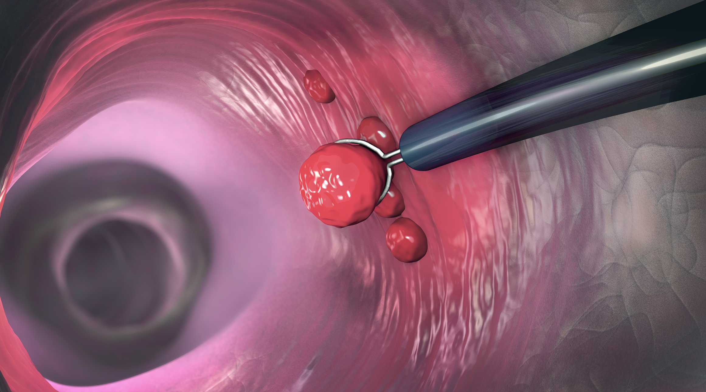 Familial Adenomatous Polyposis program